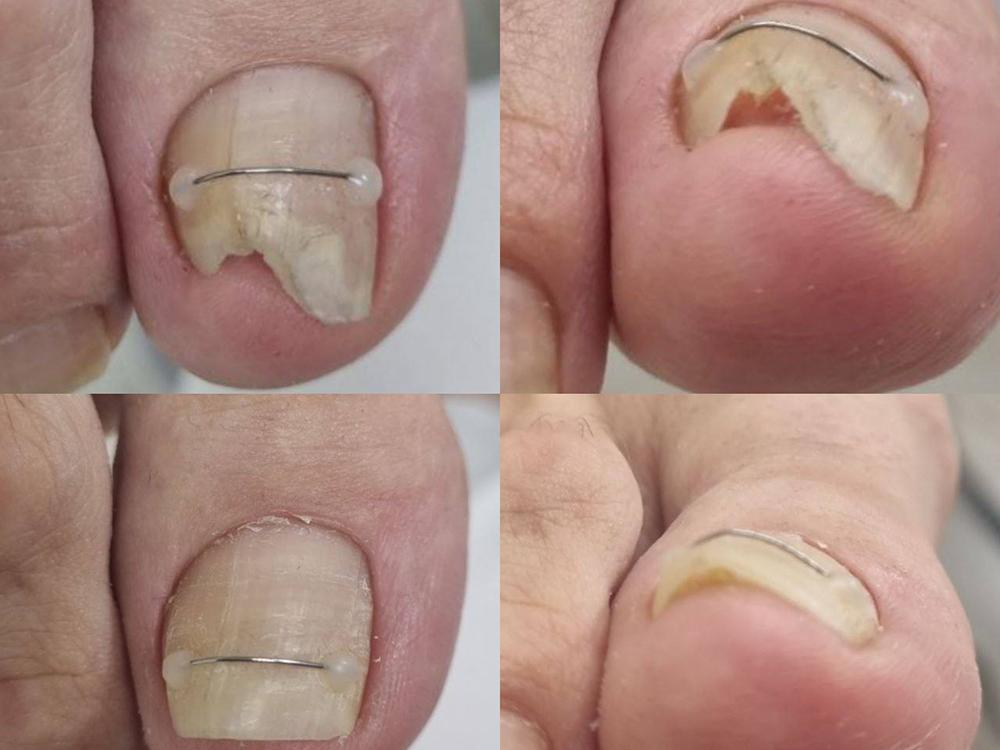 Искривление ногтевой пластины – причины, симптомы, диагностика и лечение
